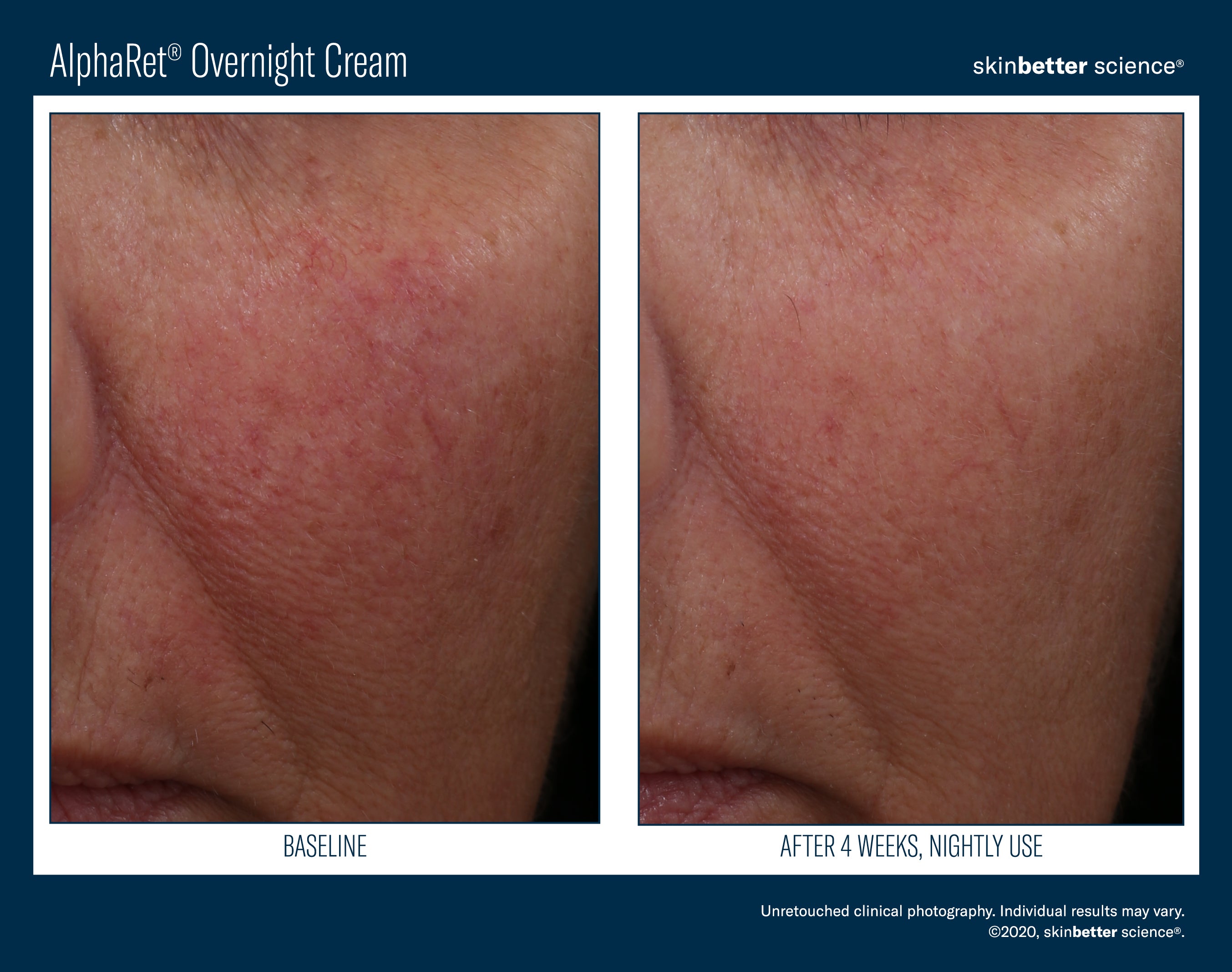 AlphaRet Overnight Cream