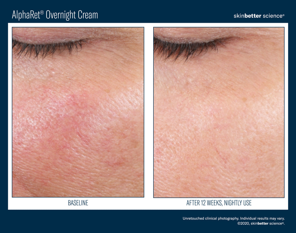 AlphaRet Overnight Cream