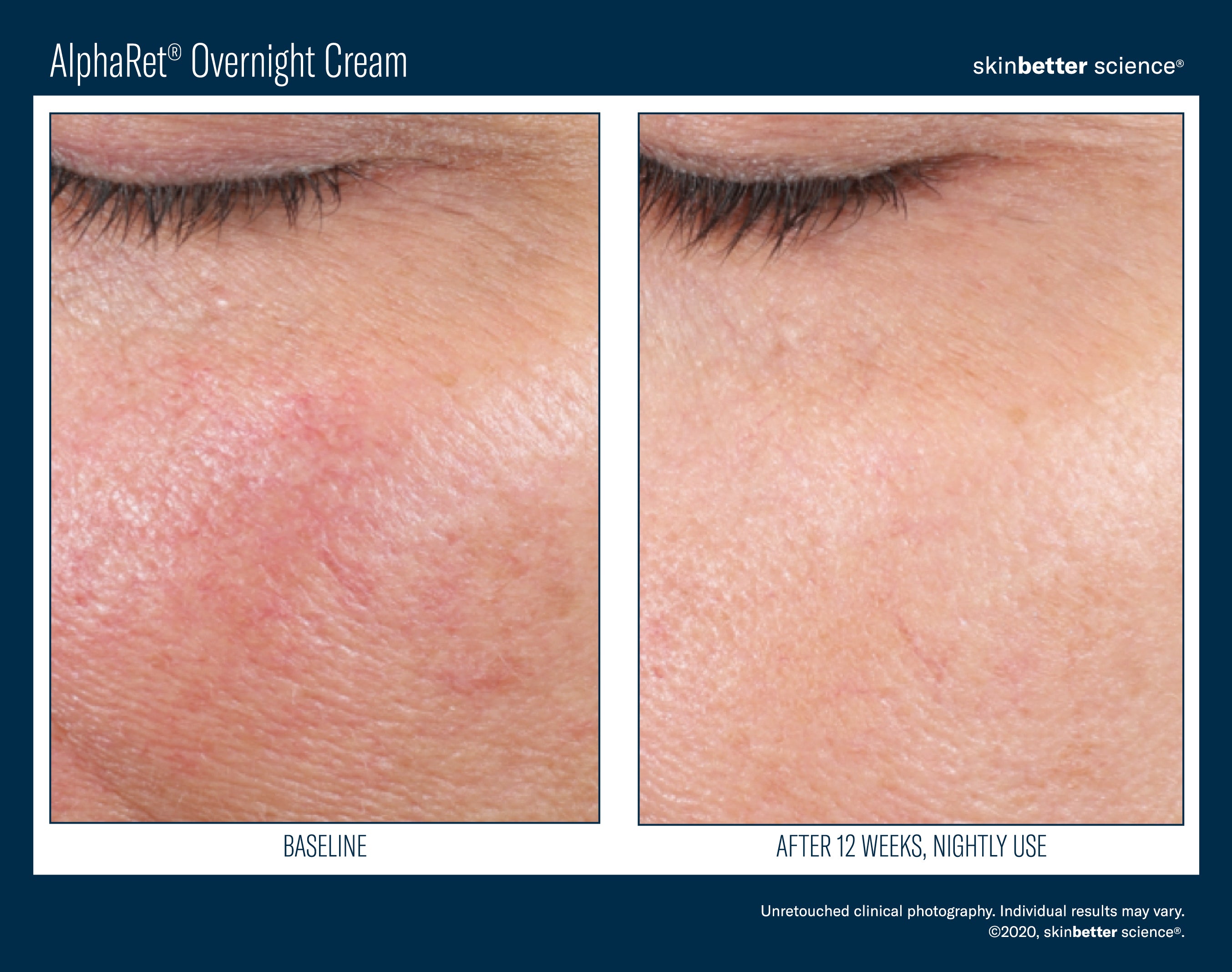 AlphaRet Overnight Cream