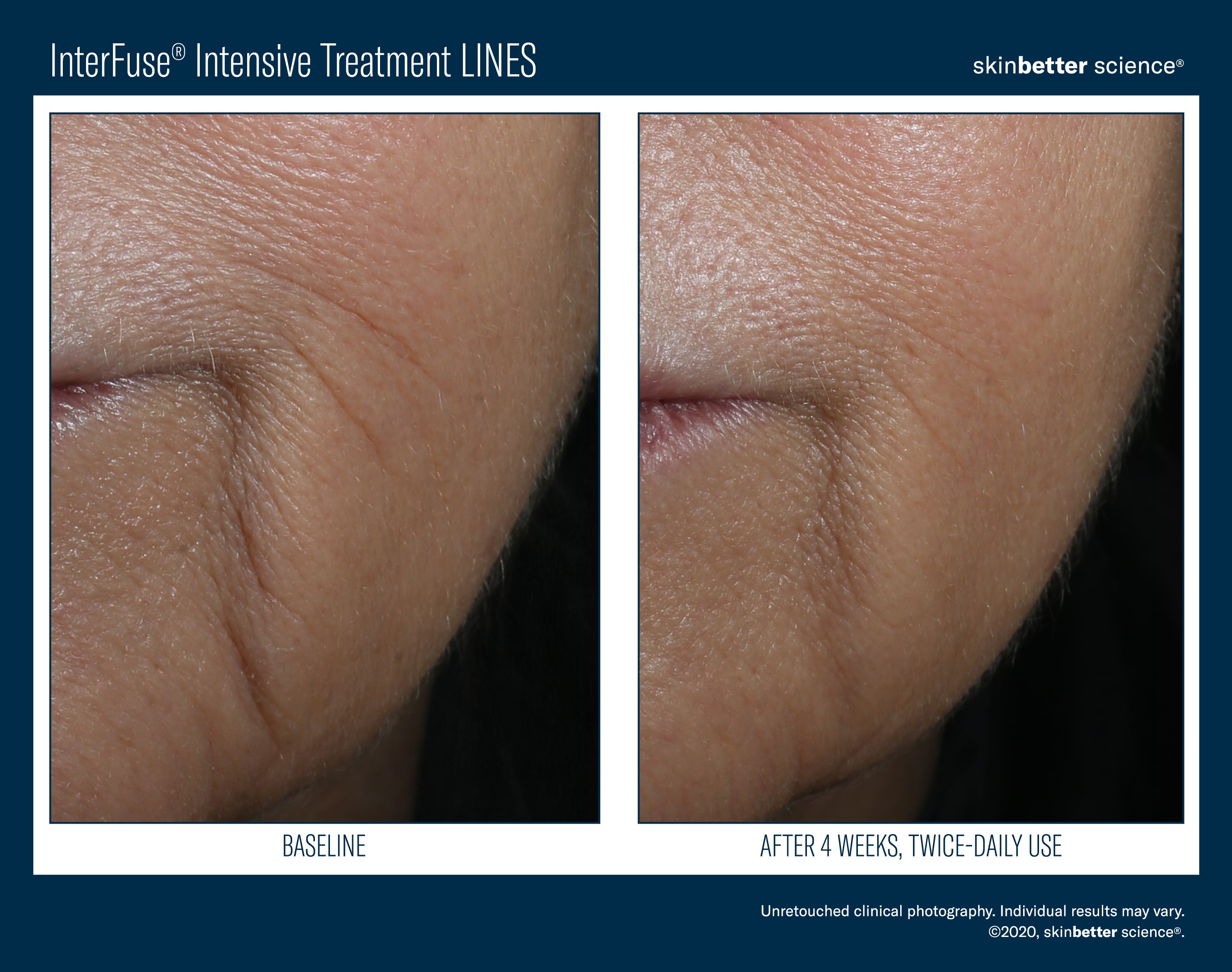 Interfuse Intensive Treatment Lines