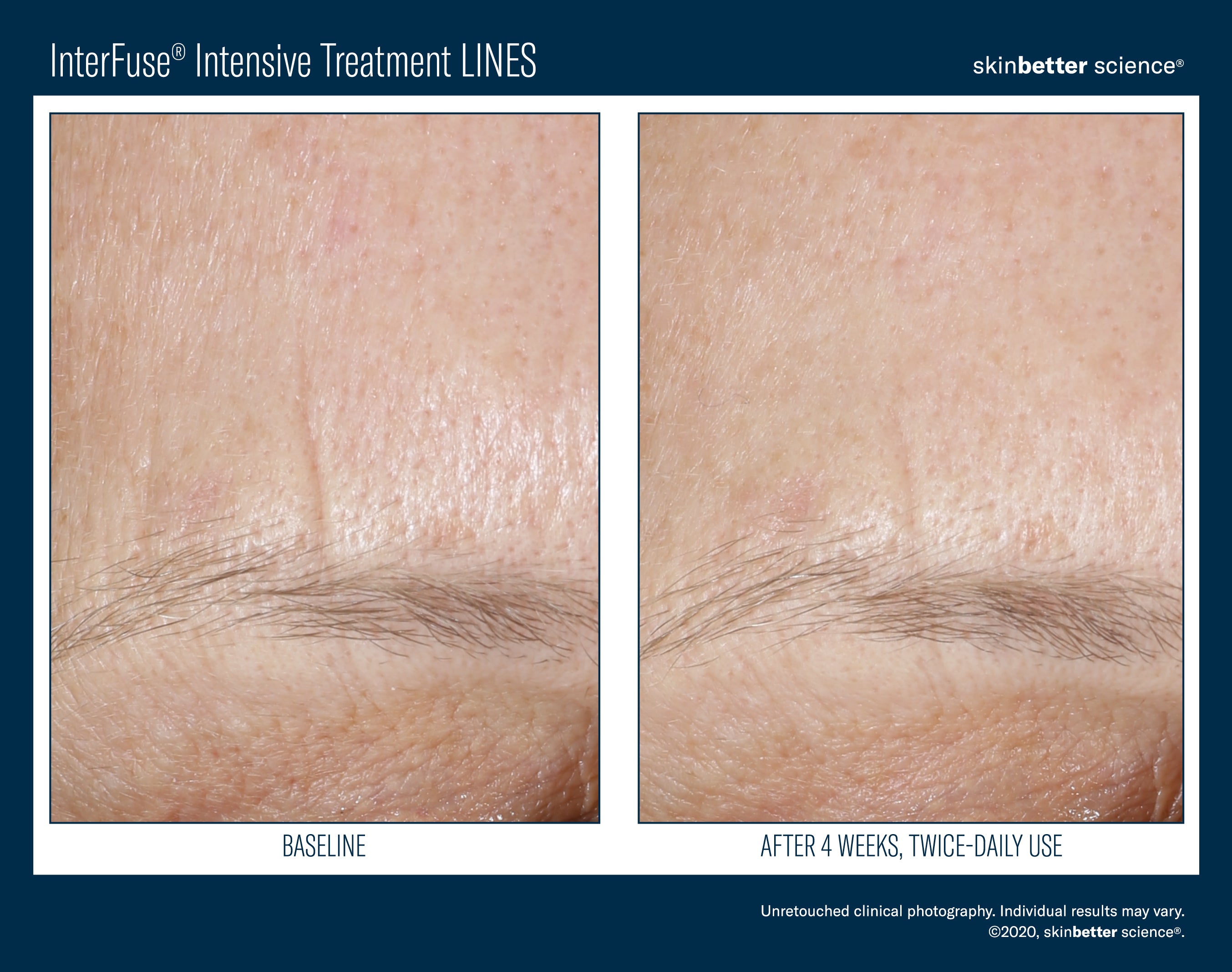Interfuse Intensive Treatment Lines