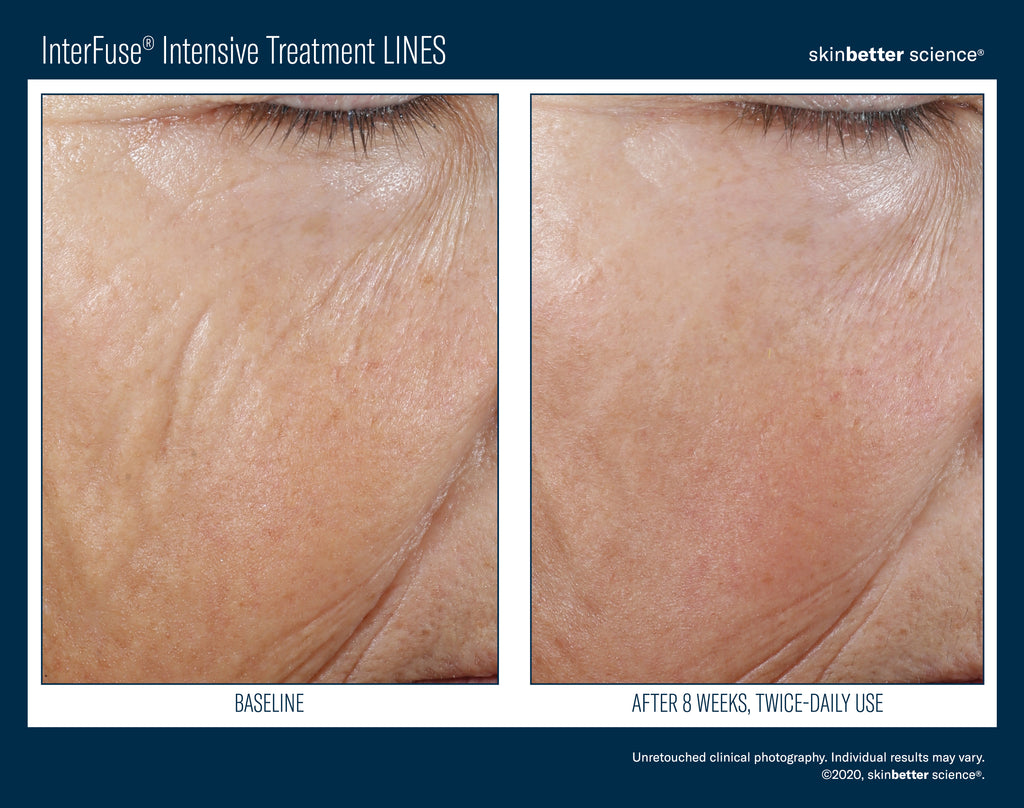 Interfuse Intensive Treatment Lines