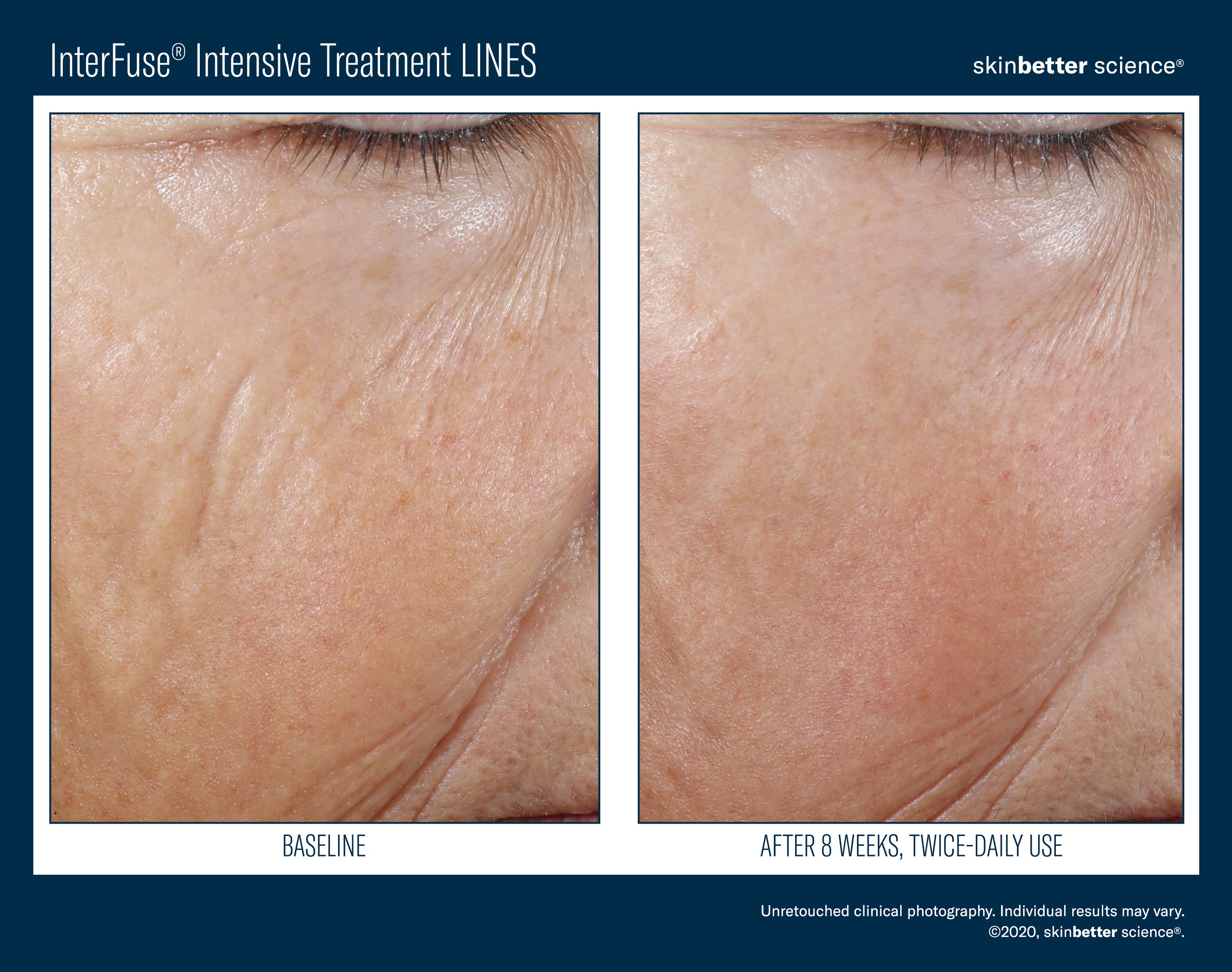 Interfuse Intensive Treatment Lines